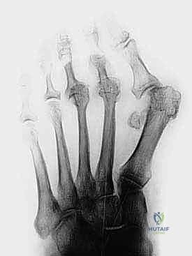 صورة توضيحية لـ عملية وايل لتصحيح قصر مشط القدم: دليل شامل لعلاج آلام مقدمة القدم وخلع المفاصل