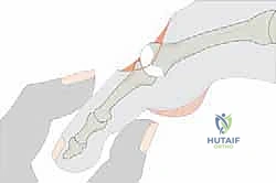 ميكانيكية عملية وايل وتقصير المشط