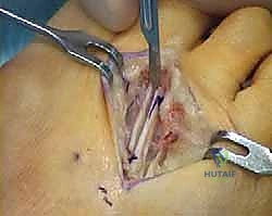 استخدام الدعامات والعلاجات التحفظية للقدم