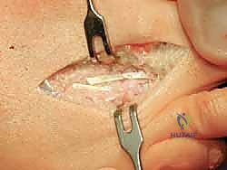 تطور تشوه الأصابع والأعراض السريرية