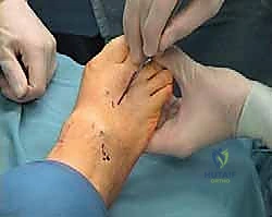 أشعة سينية توضح خلع مفاصل MTP