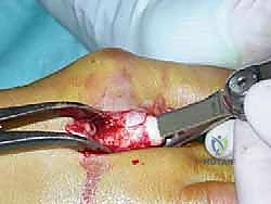 عملية وايل لتصحيح قصر مشط القدم: دليل شامل لعلاج آلام مقدمة القدم وخلع المفاصل