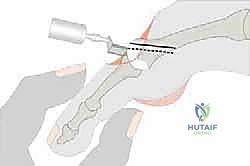 توضيح شكل المفاصل والعظام في مقدمة القدم