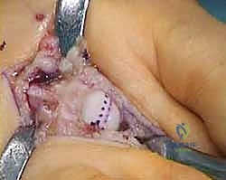 إجراء القطع العظمي بالمنشار الدقيق