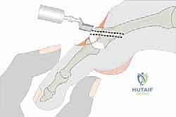 صورة توضيحية لعملية وايل لتصحيح قصر مشط القدم