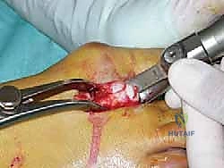 صورة توضيحية لـ عملية وايل لتصحيح قصر مشط القدم: دليل شامل لعلاج آلام مقدمة القدم وخلع المفاصل