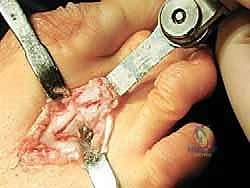 تشريح مقدمة القدم والتحضير لعملية وايل