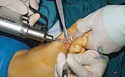 صورة توضيحية لـ عملية وايل لتصحيح قصر مشط القدم: دليل شامل لعلاج آلام مقدمة القدم وخلع المفاصل