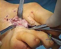 تصوير شعاعي يوضح تشوهات مشط القدم