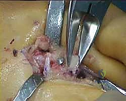 صورة توضيحية لـ عملية وايل لتصحيح قصر مشط القدم: دليل شامل لعلاج آلام مقدمة القدم وخلع المفاصل