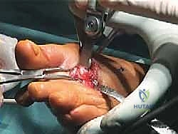 صورة طبية: عملية وايل لتصحيح قصر مشط القدم: دليل شامل لعلاج آلام مقدمة القدم وخلع المفاصل