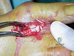 تأثير الخلل الميكانيكي على مفاصل القدم