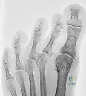 إصبع القدم المطرقية