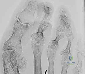 استخدام الوسائد السيليكونية لحماية الأصابع