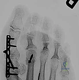 تمارين إطالة وعلاج طبيعي للقدم