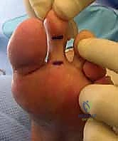 صورة توضيحية لـ تشوهات أصابع القدم الصغيرة: دليل شامل للعلاج الجراحي وغير الجراحي مع الأستاذ الدكتور محمد هطيف في صنعاء