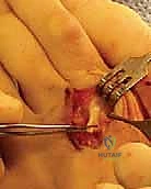 تثبيت الإصبع باستخدام سلك معدني K-wire