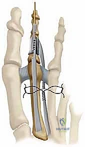 صورة توضيحية لـ تشوهات أصابع القدم الصغيرة: دليل شامل للعلاج الجراحي وغير الجراحي مع الأستاذ الدكتور محمد هطيف في صنعاء