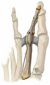 صورة توضيحية لـ تشوهات أصابع القدم الصغيرة: دليل شامل للعلاج الجراحي وغير الجراحي مع الأستاذ الدكتور محمد هطيف في صنعاء