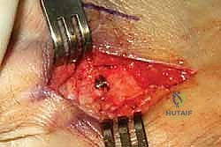 تصحيح الإصبع الخامس المتصالب جراحياً