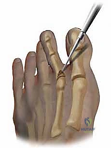 صورة توضيحية لـ تشوهات أصابع القدم الصغيرة: دليل شامل للعلاج الجراحي وغير الجراحي مع الأستاذ الدكتور محمد هطيف في صنعاء