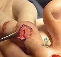 صورة توضيحية لـ تشوهات أصابع القدم الصغيرة: دليل شامل للعلاج الجراحي وغير الجراحي مع الأستاذ الدكتور محمد هطيف في صنعاء