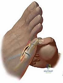 تورم واحمرار في مفاصل الأصابع