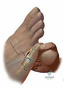 تحديد زوايا التشوه بدقة