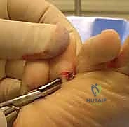 Illustration of flexor to extensor - Dr. Mohammed Hutaif