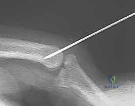 Dorsal Block Pinning for Proximal Interphalangeal Joint Fracture-Dislocations