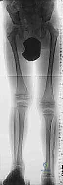 صورة توضيحية لـ إطالة الأطراف: تقنيات إليزاروف والمثبت أحادي المستوى لاستعادة الطول والوظيفة مع الأستاذ الدكتور محمد هطيف