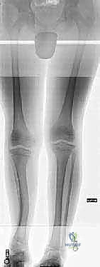صورة توضيحية لـ إطالة الأطراف: تقنيات إليزاروف والمثبت أحادي المستوى لاستعادة الطول والوظيفة مع الأستاذ الدكتور محمد هطيف