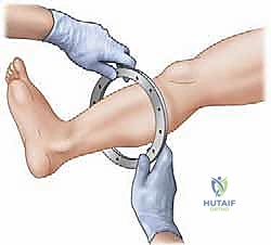 صورة طبية: إطالة الأطراف: تقنيات إليزاروف والمثبت أحادي المستوى لاستعادة الطول والوظيفة مع الأستاذ الدكتور محمد هطيف
