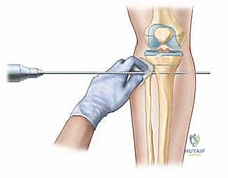 الخيارات العلاجية لإطالة الأطراف