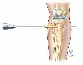 المثبت أحادي المستوى في جراحة العظام