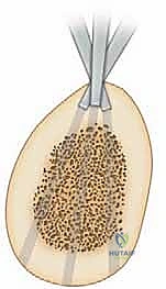 مرحلة الشد وتوليد العظم