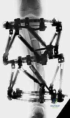 جهاز إليزاروف الدائري