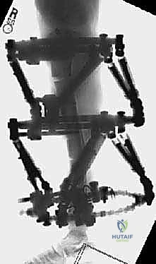 خطوات جراحة إطالة الأطراف