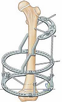 أعراض تفاوت طول الأطراف