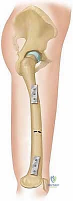 مقارنة بين مثبتات العظام الخارجية