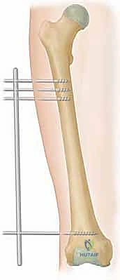 مرحلة تصلب العظم الجديد