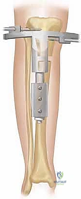 توليد العظم بالشد في إطالة الأطراف