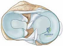 أنواع تمزقات الغضروف الهلالي وتشريح الركبة