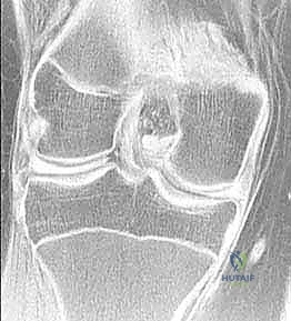 إصلاح الغضروف الهلالي بالمنظار: دليلك الشامل للحفاظ على ركبتك مع الأستاذ الدكتور محمد هطيف