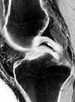 التأهيل والعلاج الطبيعي بعد جراحة الغضروف الهلالي