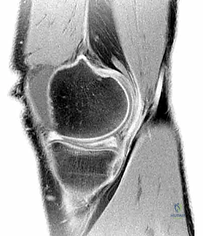 تقنيات خياطة الغضروف الهلالي المتطورة