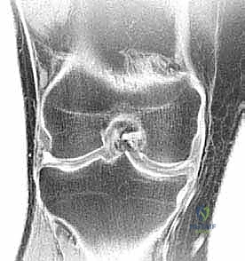 التحضير لعملية المنظار الجراحي للركبة