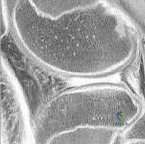 صورة شعاعية بالرنين المغناطيسي توضح تمزق الغضروف الهلالي