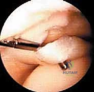 Illustration of meniscal repair meniscal - Dr. Mohammed Hutaif