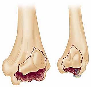 Masterclass: ORIF of Capitellum and Capitellar–Trochlear Shear Fractures